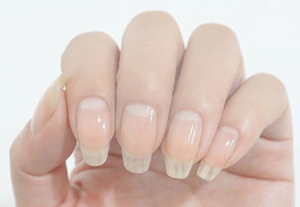 手足癬的護理方法有哪些