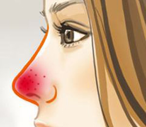 長春治療酒槽鼻醫(yī)院_酒槽鼻的癥狀都有哪些