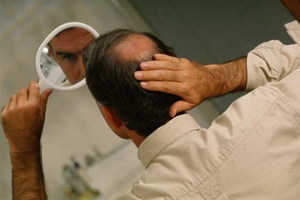 哪些方法可以防止斑禿疾病加劇