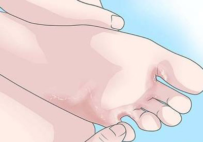 灰指甲的護理需求注意以下幾點: