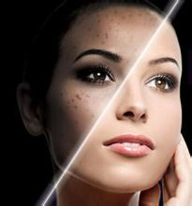 如何才能有效的祛除痘痘和痘印