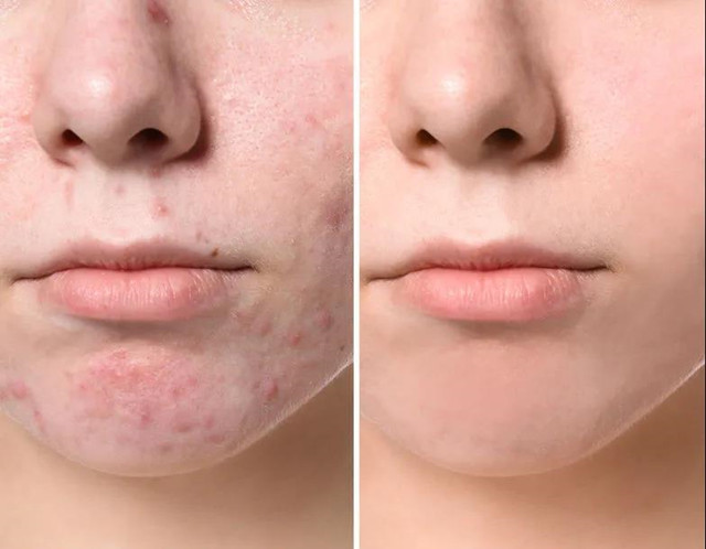 為什么點陣激光能去痘坑