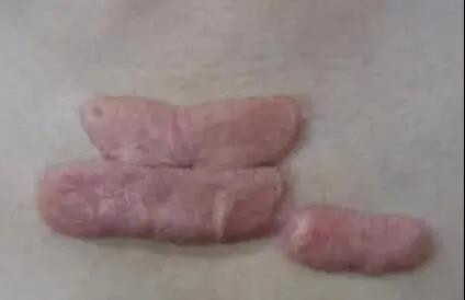 疤痕疙瘩為什么越長越大