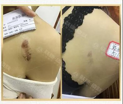 疤痕疙瘩為什么越長越大