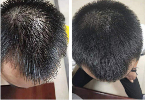 脂溢性脫發如何治療比較好