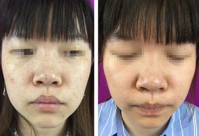 激光祛斑長春哪家醫院比較好