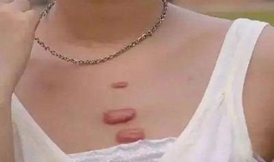 長春如何治療疤痕疙瘩