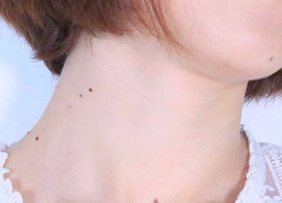 脖子上長小肉疣長春哪里能治