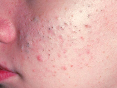 臉上有痘痘如何正確飲食