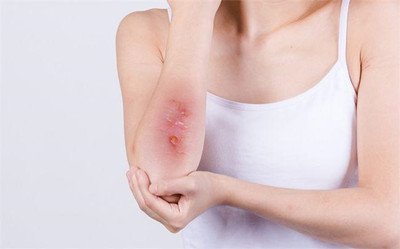 瘢痕增生是由什么原因引起的