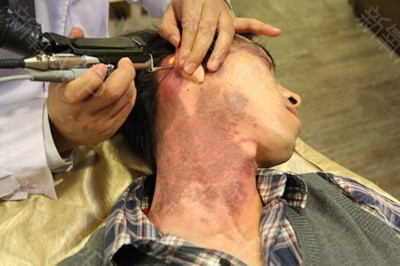 用激光祛斑效果怎么樣