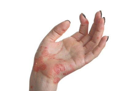 如何預防春末夏初的皮膚疾病