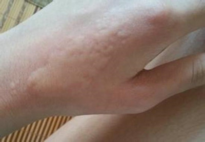 如何預防春末夏初的皮膚疾病