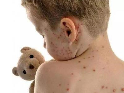 玫瑰糠疹是怎么引起的