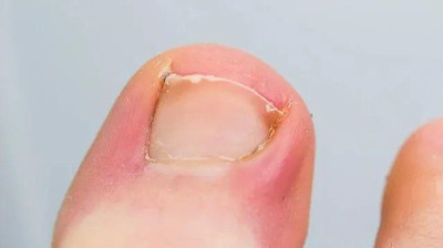 甲溝炎指甲已經(jīng)扎進(jìn)肉里怎么辦