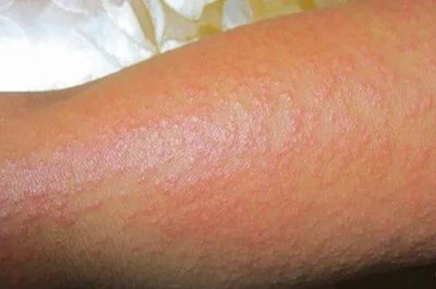 夏季常見的五種皮膚病有哪些?怎么預(yù)防