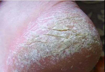 夏季常見的五種皮膚病有哪些?怎么預(yù)防