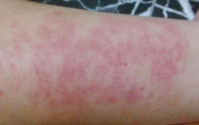 夏季常見的五種皮膚病有哪些?怎么預(yù)防