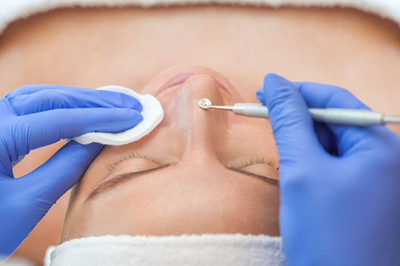 黑頭怎么去除最有效