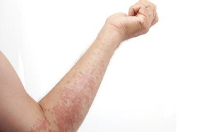 濕疹是因為皮膚太潮濕了嗎?濕疹的發(fā)病原因到底是什么