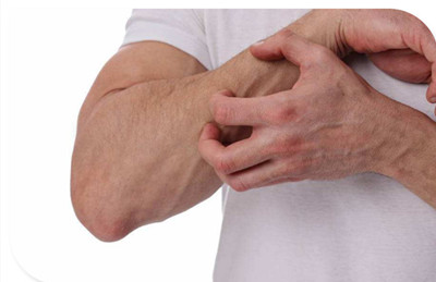 濕疹是因為皮膚太潮濕了嗎?濕疹的發(fā)病原因到底是什么