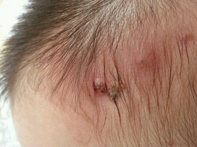 頭上長膿包瘡是什么原因引起的