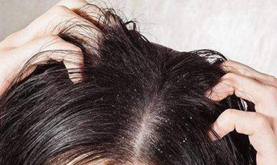 頭上長癬的原因有哪些