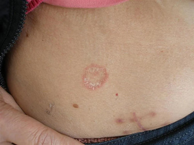 夏季體癬找上門,患病人群要小心