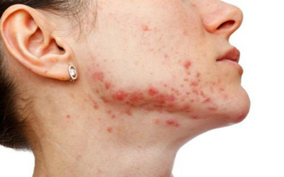 秋季高發(fā)的皮膚病有哪些?如何預(yù)防