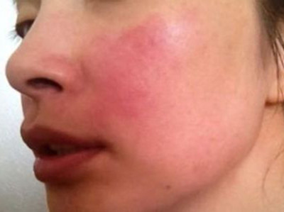 臉不知道什么原因過敏了怎么辦?