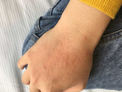 哪些皮膚疾病會誘發(fā)皮膚瘙癢