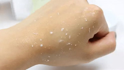 脂溢性皮炎可以自愈嗎