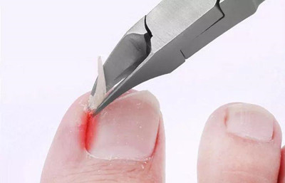 嵌甲如何自己處理