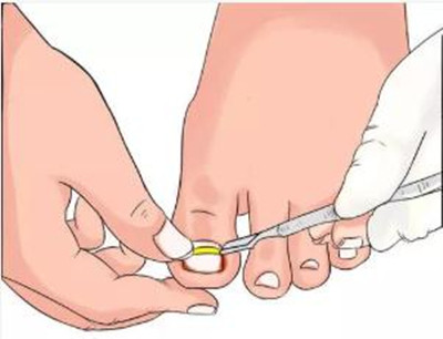 甲溝炎要拔掉整個指甲嗎