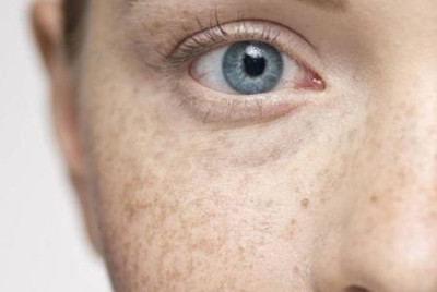 黃褐斑怎樣才能徹底的去掉