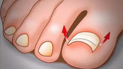 甲溝炎去醫(yī)院掛什么科