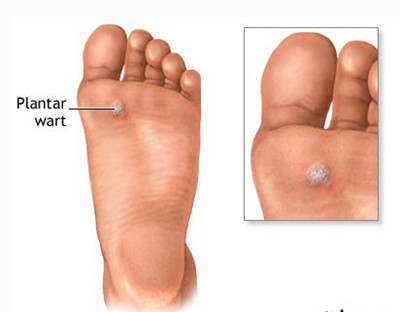 跖疣會不會傳染