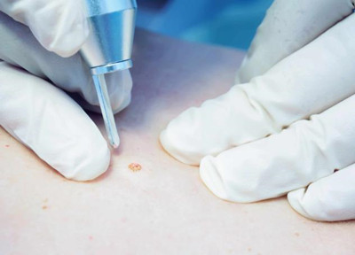 傳染性軟疣怎么治療