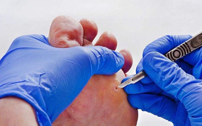 雞眼是什么原因引起的