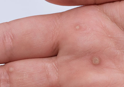 尋常疣是什么樣子的