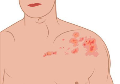 得了帶狀性皰疹需要注意什么