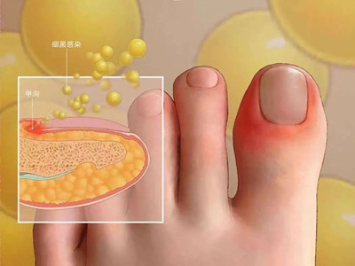 怎么判斷自己是否得了甲溝炎