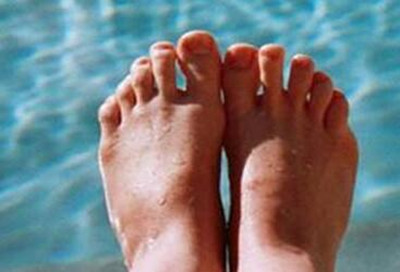 足癬的癥狀和治療方法