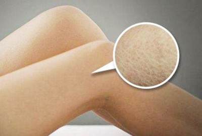 魚鱗病如何才能治好