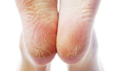 如何改善足底皸裂
