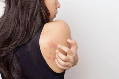 膽堿性蕁麻疹能治好嗎