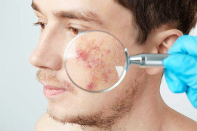 胎記的發病原因和種類