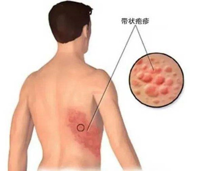 “蛇盤瘡”春季高發,小心“蛇進腦”!