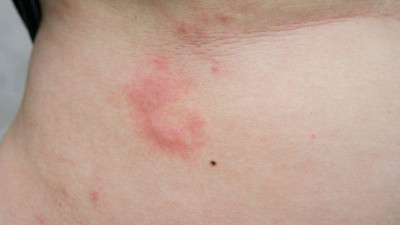 去胎記后的紅印怎么處理