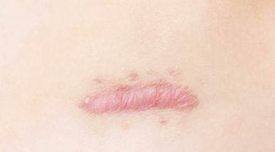 疤痕增生能徹底治愈嗎